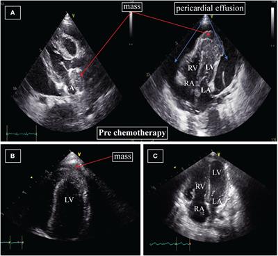 Case report: Clinical features of pediatric acute myeloid leukemia presenting with cardiac tamponade: a case series study and literature review